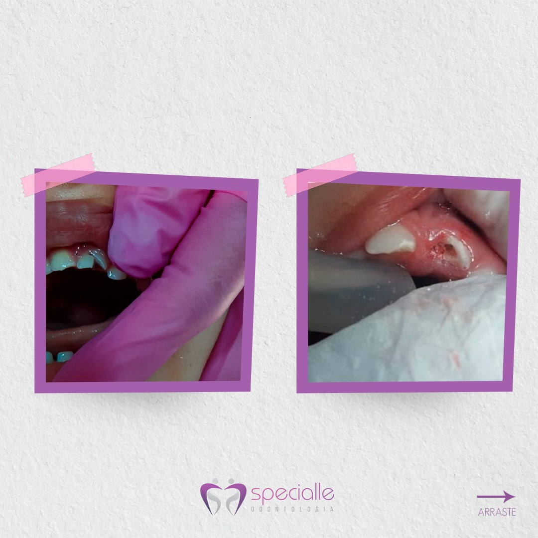 TRAUMATISMO DENTÁRIO